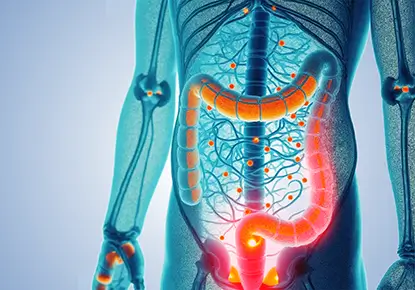 Ulcerative Colitis